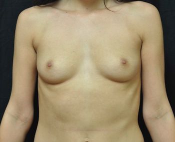Breast Augmentation before and after - before