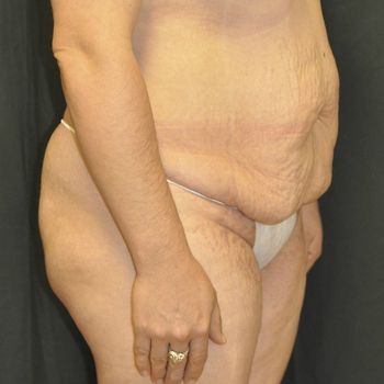 Tummy Tuck before and after - before