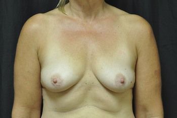 Breast Augmentation by Dr. Andrew Smith — before and after