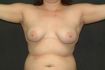 Breast Lift by Dr. Andrew Smith — before and after