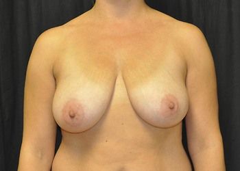 Breast Lift by Dr. Andrew Smith — before