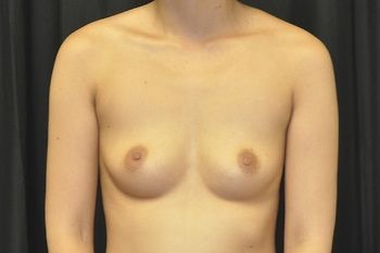 Breast Augmentation before and after - before
