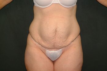 Tummy Tuck before and after - before
