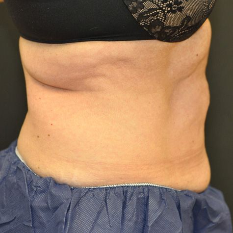 Procedure before and after - before