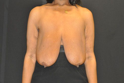 Breast Lift by Dr. Andrew Smith — before and after