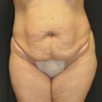 Tummy Tuck before and after - before