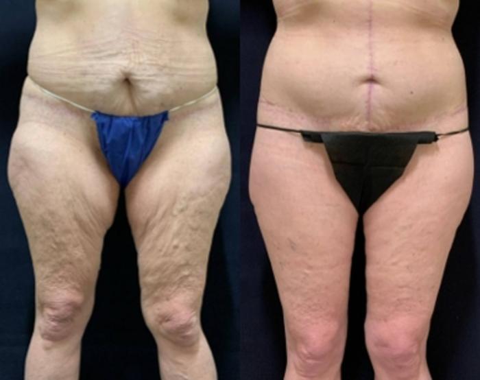 Body Contouring before and after - after