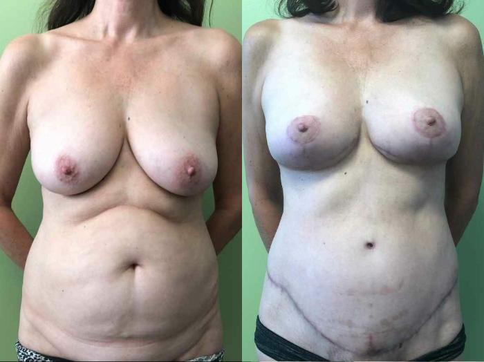 Breast Lift before and after - after
