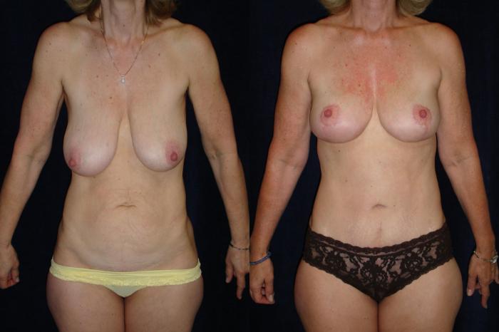 Breast Lift before and after - before