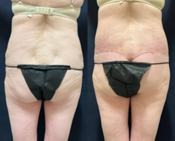 Breast Reduction before and after - before