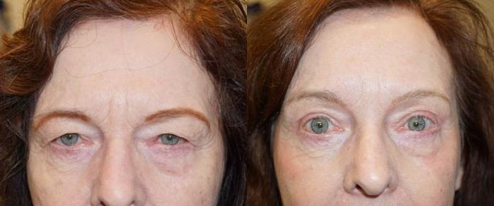 Brow Lift before and after - before
