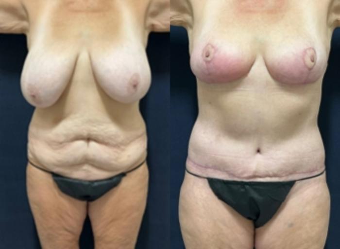 Body Contouring before and after - before