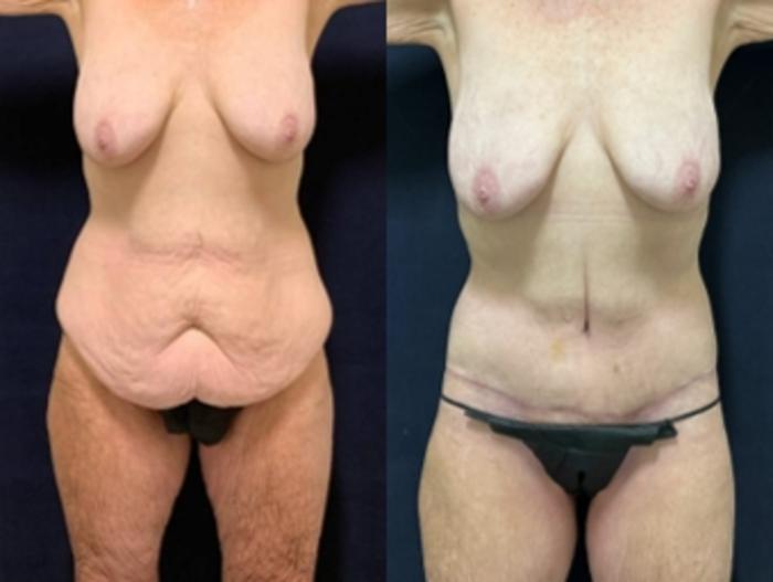 Body Contouring before and after - before