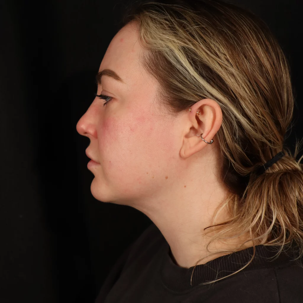 Neck Liposuction before and after - after