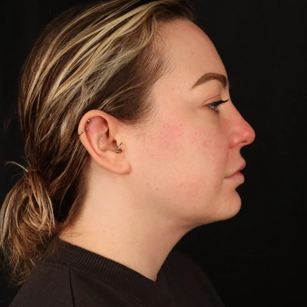 Neck Liposuction before and after - after