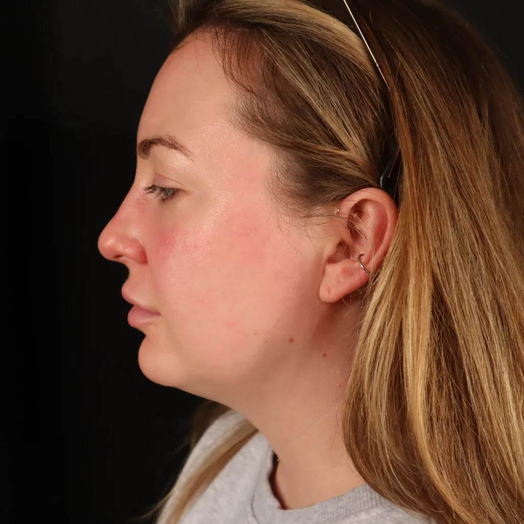 Neck Liposuction before and after - before