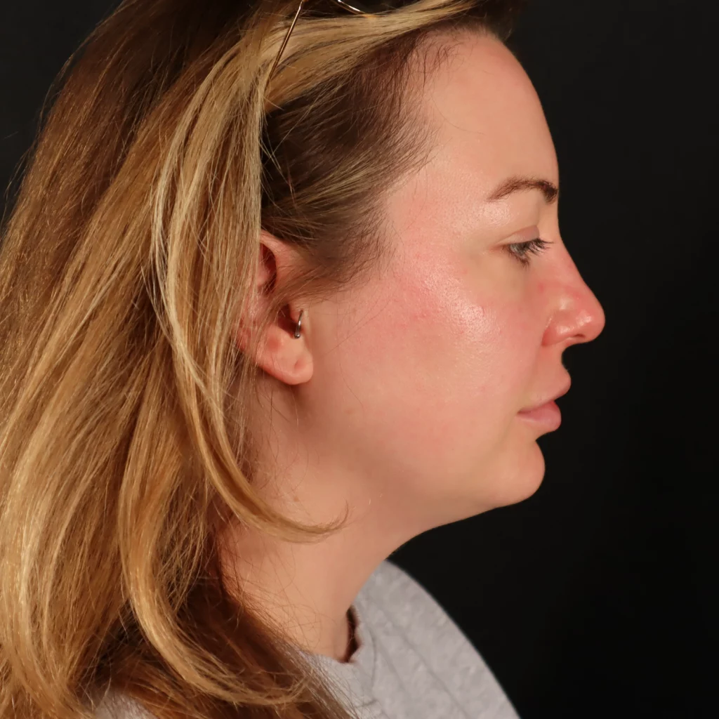 Neck Liposuction before and after - before
