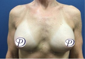 Breast Augmentation before and after - after