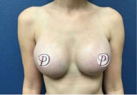 Breast Augmentation before and after - after