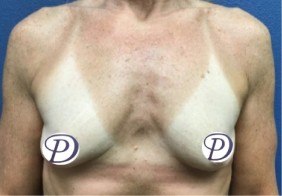 Breast Augmentation before and after - before