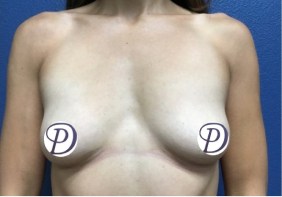 Breast Augmentation before and after - before