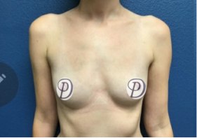 Breast Augmentation before and after - before