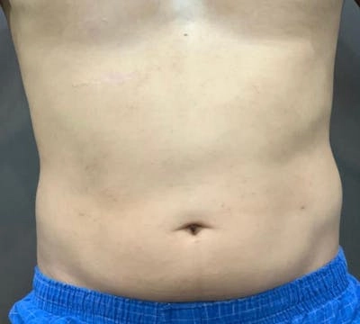 Other procedures by Dr. Kyle Song — after