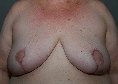 Breast Reduction before and after - after