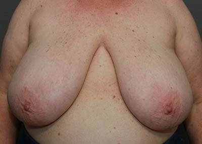 Breast Reduction by Dr. Kyle Song — before and after