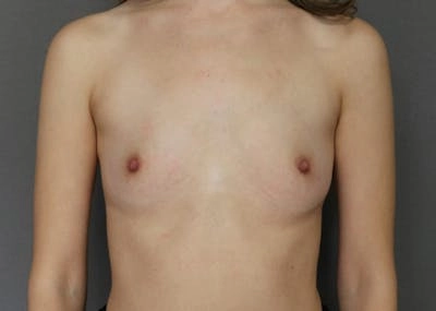 Breast Augmentation by Dr. Kyle Song — before and after