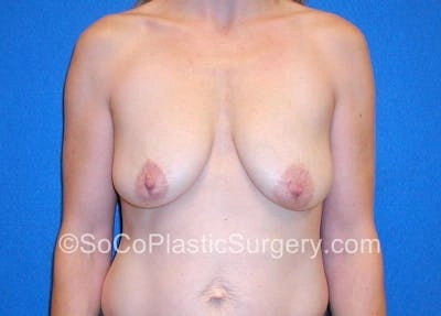 Breast Lift by Dr. Kyle Song — before