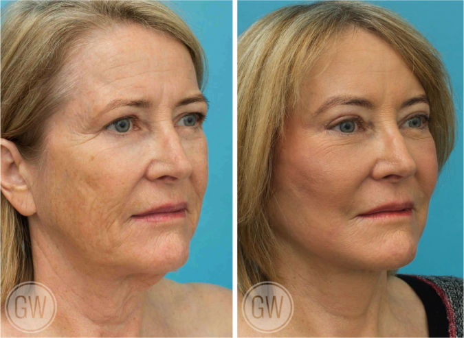 Temporal brow lift + Upper blepharoplasty + Facelift + Necklift + TCA peel before and after - after