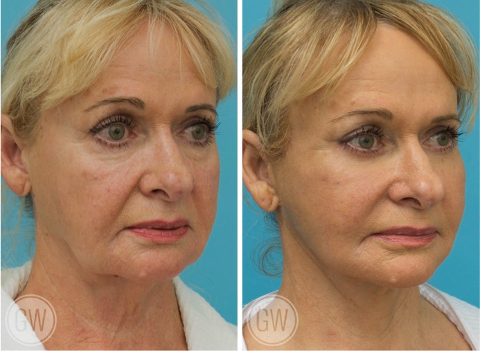 Facelift + necklift + upper and lower eyelid surgery + facial fat grafting + 35% TCA Peel before and after - after