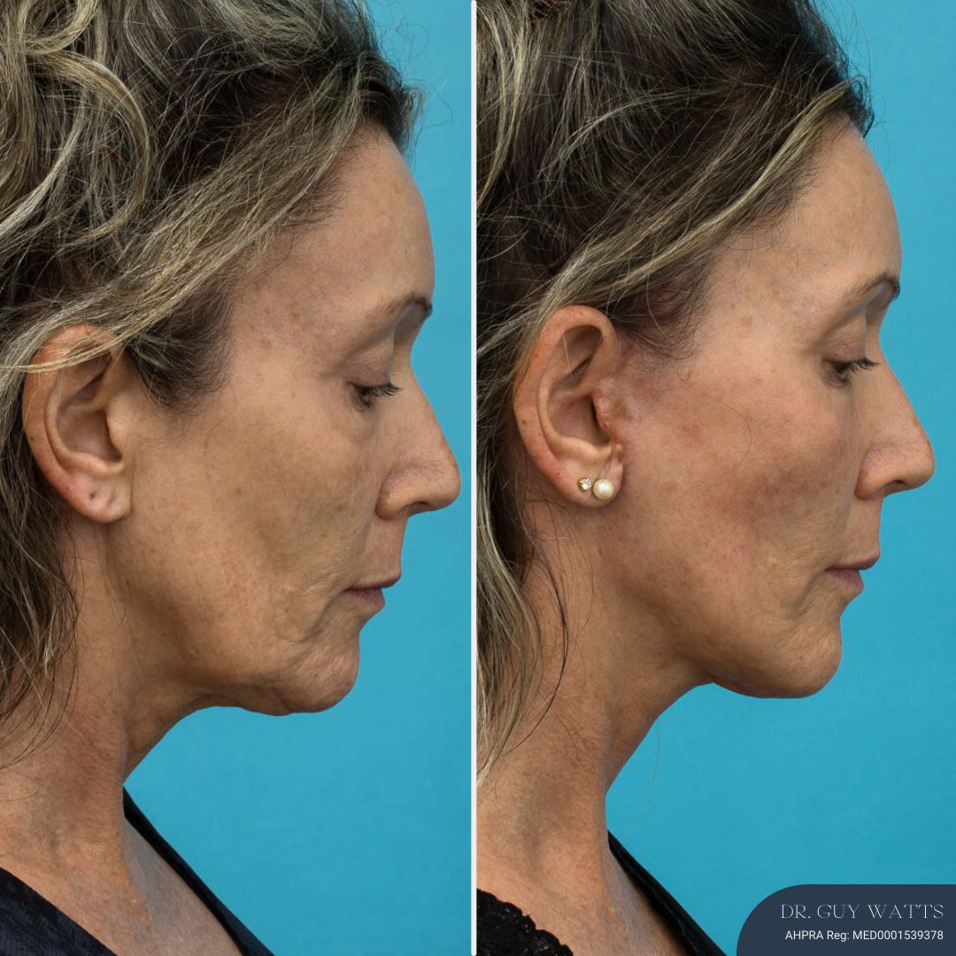 3 Months Post-op Rhinoplasty + Face and Neck Lift + Upper and Lower Blepharoplasty before and after - after