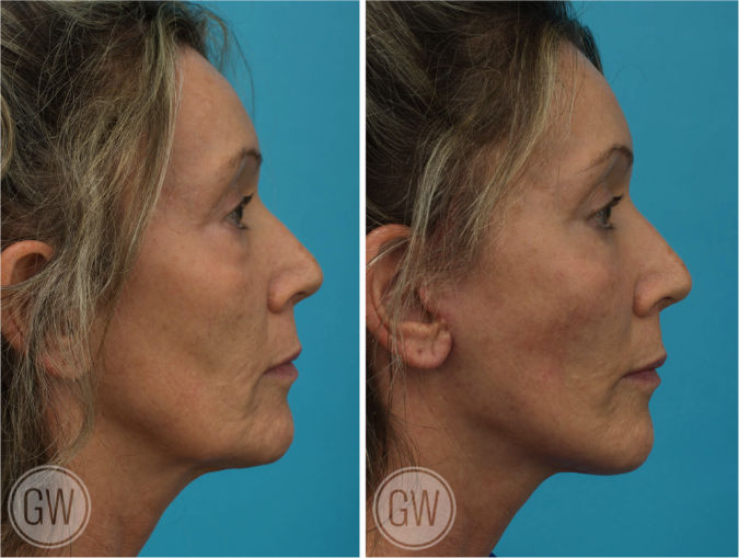 Facelift + Necklift + Lower Eyelid Surgery before and after - after