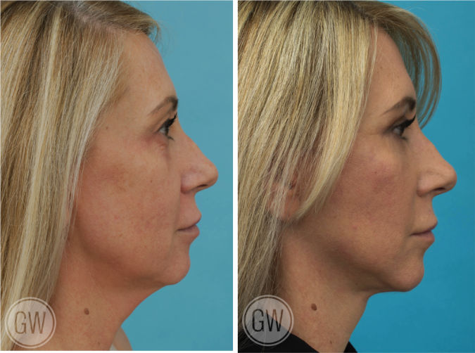 Facelift + Necklift + Upper + Lower Eyelid Surgery before and after - after
