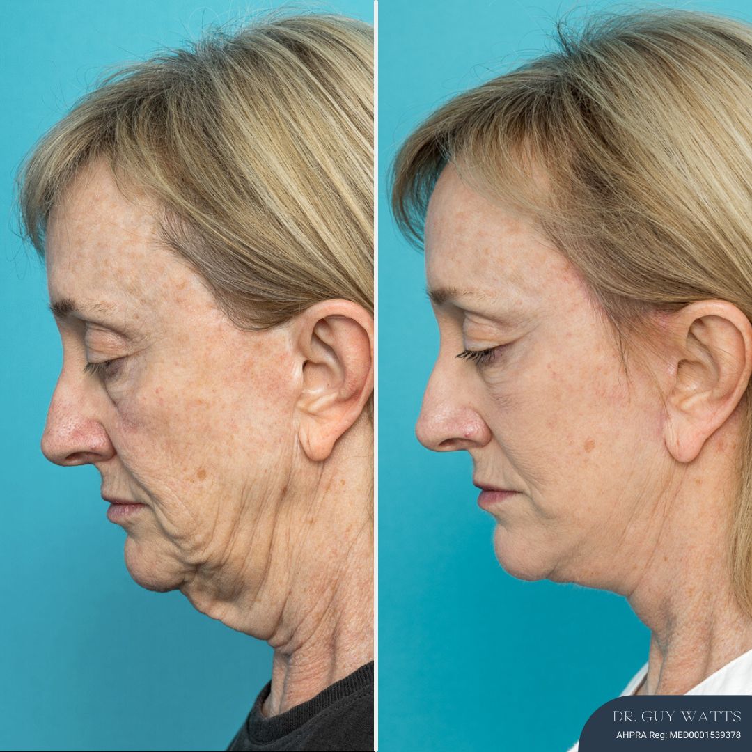 12 Months Post-op Face Lift and Posterior Neck Lift before and after - after