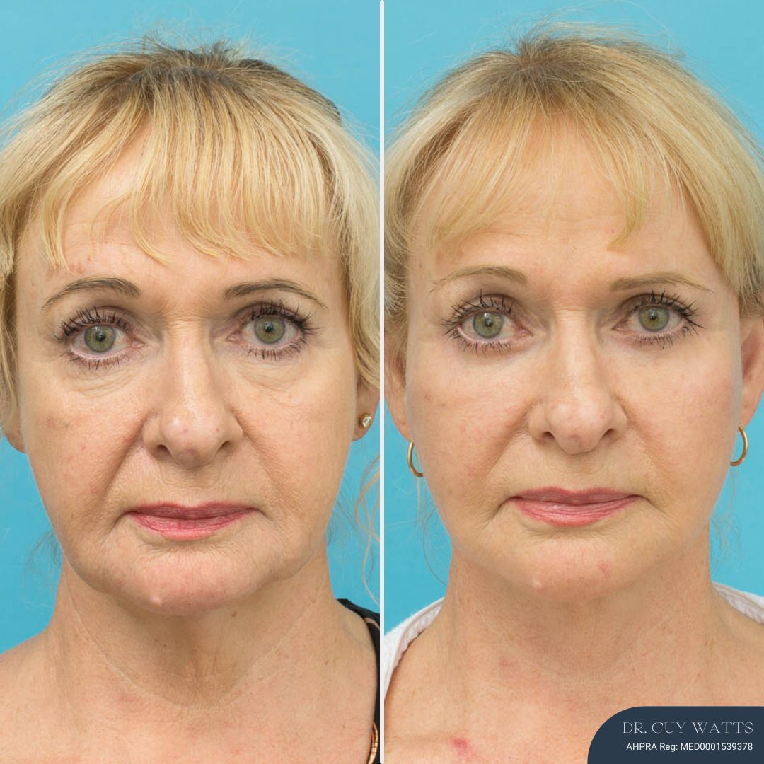 4 Months Post Face and posterior necklift + Temporal browlift + bilateral canthoplasty + fat grafting + TCA peel before and after - after