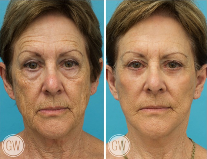 Facelift + neck lift + upper and lower eyelid surgery before and after - after