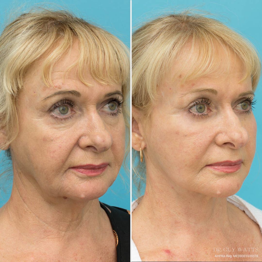 4 Months Post Face and posterior necklift + Temporal browlift + bilateral canthoplasty + fat grafting + TCA peel before and after - before