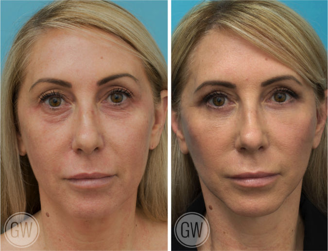 Facelift + Necklift + Upper + Lower Eyelid Surgery before and after - before