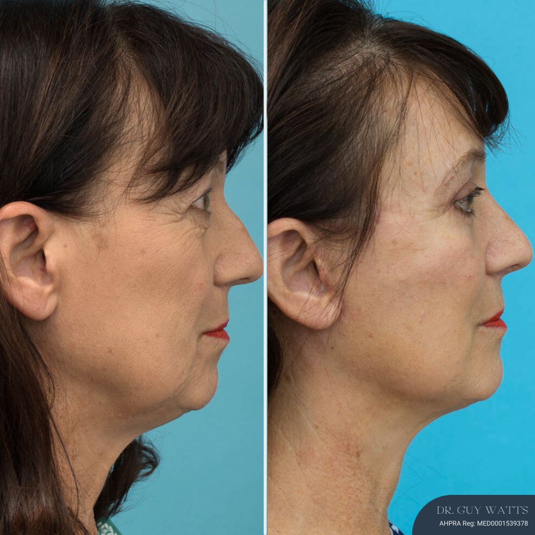 3 Months Post-op Rhinoplasty + Face and Neck Lift + Upper and Lower Blepharoplasty before and after - before