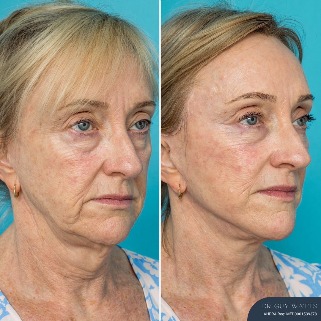 12 Months Post-op Face Lift and Posterior Neck Lift before and after - before