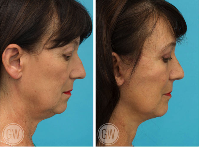 Facelift + neck lift + upper and lower eyelid surgery before and after - before