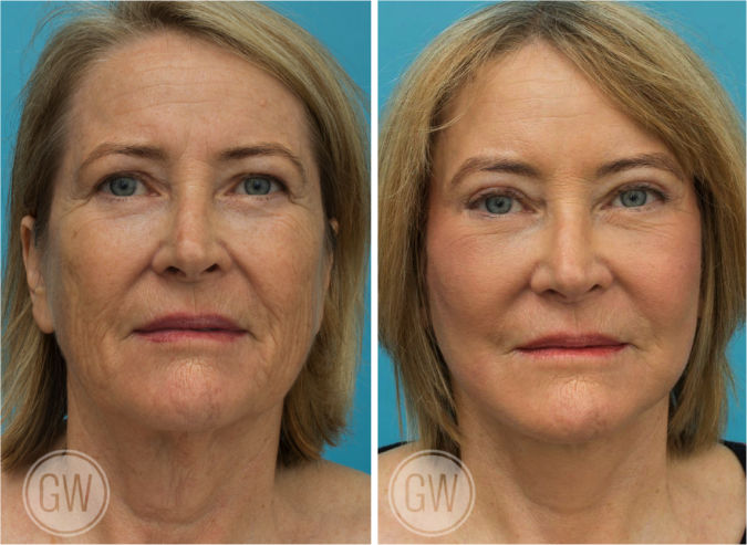 Temporal brow lift + Upper blepharoplasty + Facelift + Necklift + TCA peel before and after - before