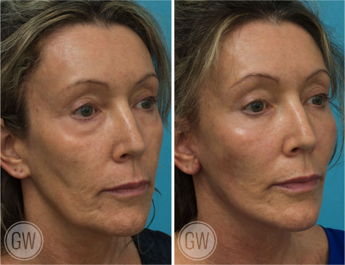 Facelift + Necklift + Lower Eyelid Surgery before and after - before