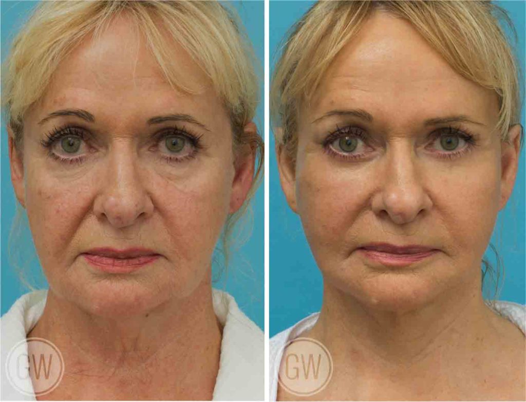 Facelift + necklift + upper and lower eyelid surgery + facial fat grafting + 35% TCA Peel before and after - before