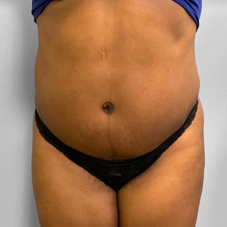 BBL, Tummy Tuck, & Liposuction by Dr. Ali Qureshi — after