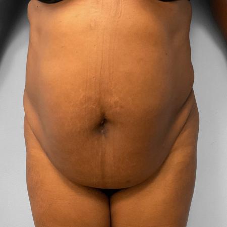 BBL, Tummy Tuck, & Liposuction by Dr. Ali Qureshi — before