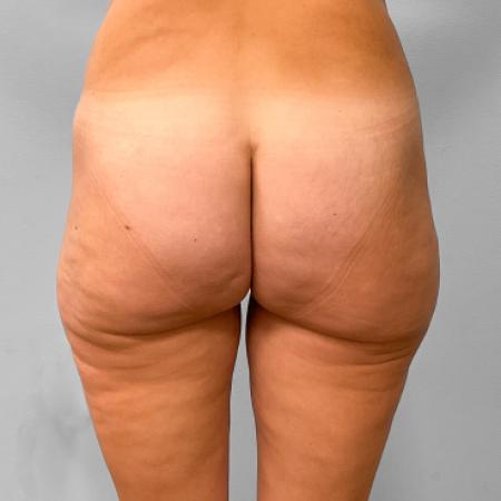 Butt Lift by Dr. Ali Qureshi — before and after